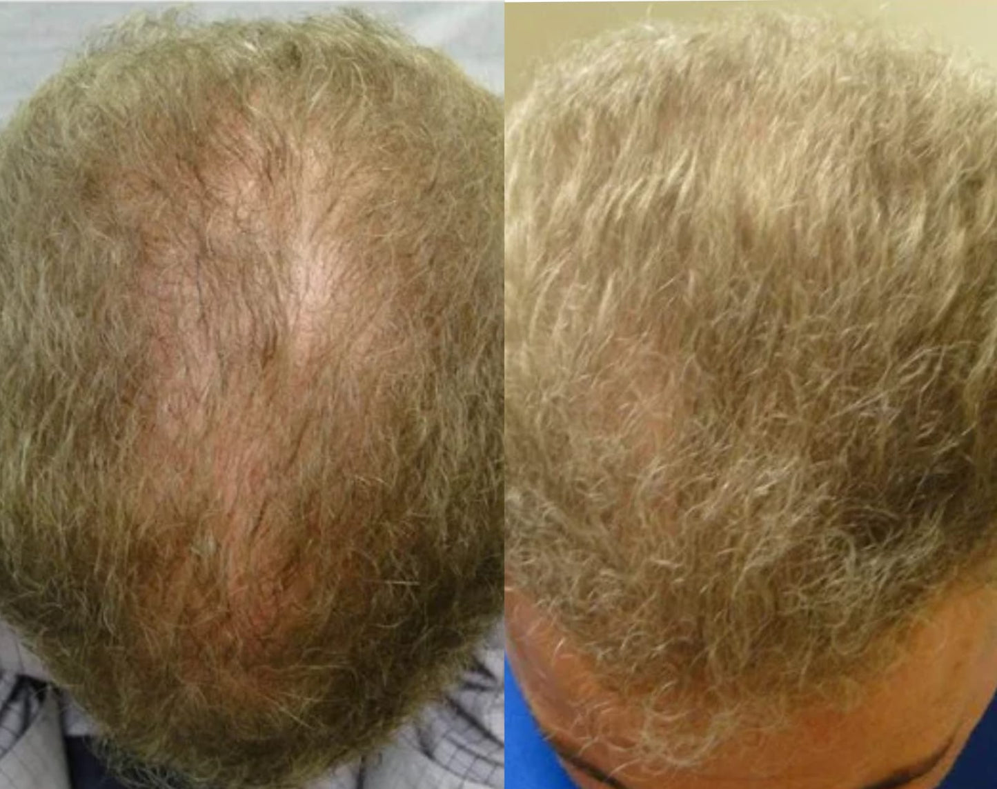 Elixir Activo 4S - Fuerza y densidad visibles en 4 semanas Beauty & Health - Hair Care & Styling - Hair Loss Products | Zulter VIP